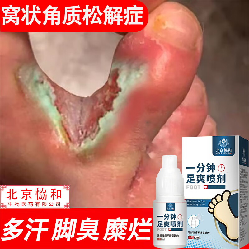 川井喷剂窝状角质松解症喷剂脚汗脚臭特傚效脚臭克星止痒脱 5盒周期装