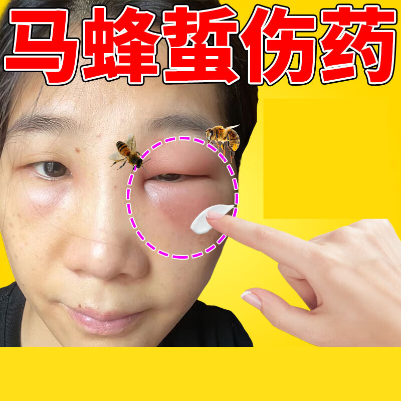 蜜蜂蛰伤膏   马蜂蛰伤蜜蜂叮咬缓解红肿止疼痛拔毒专用蜜蜂蛰伤药 一