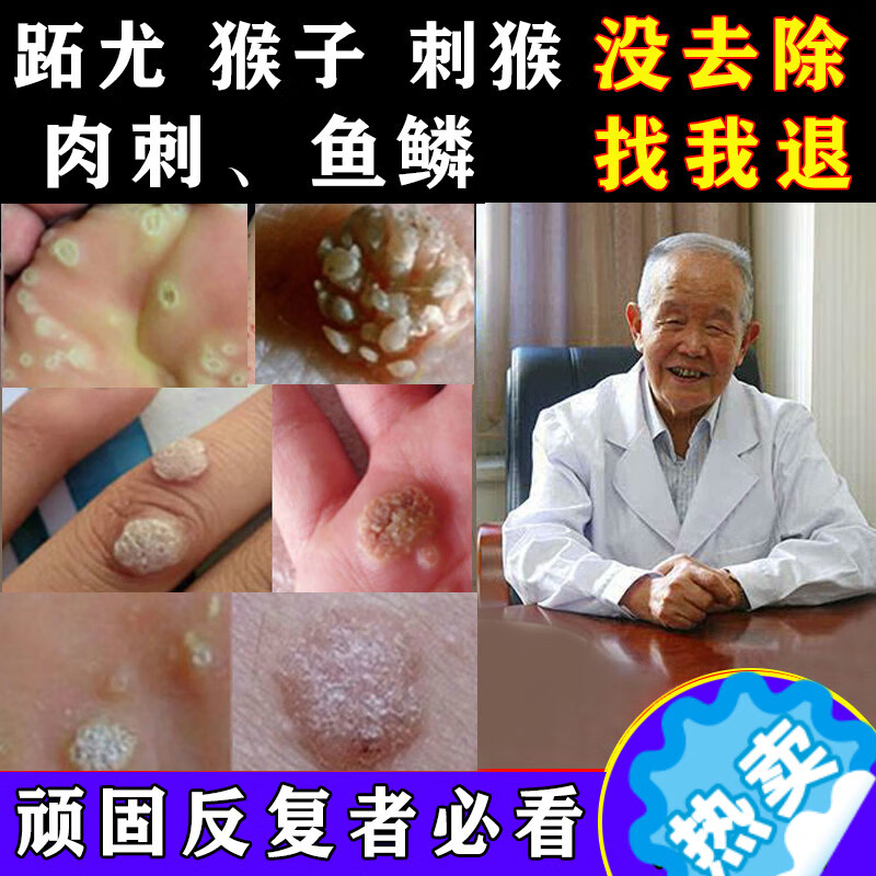 京健康子的药肉粒疙瘩鱼鳞痣休子点瘊子痦子治肉刺去除手 肉刺去除手