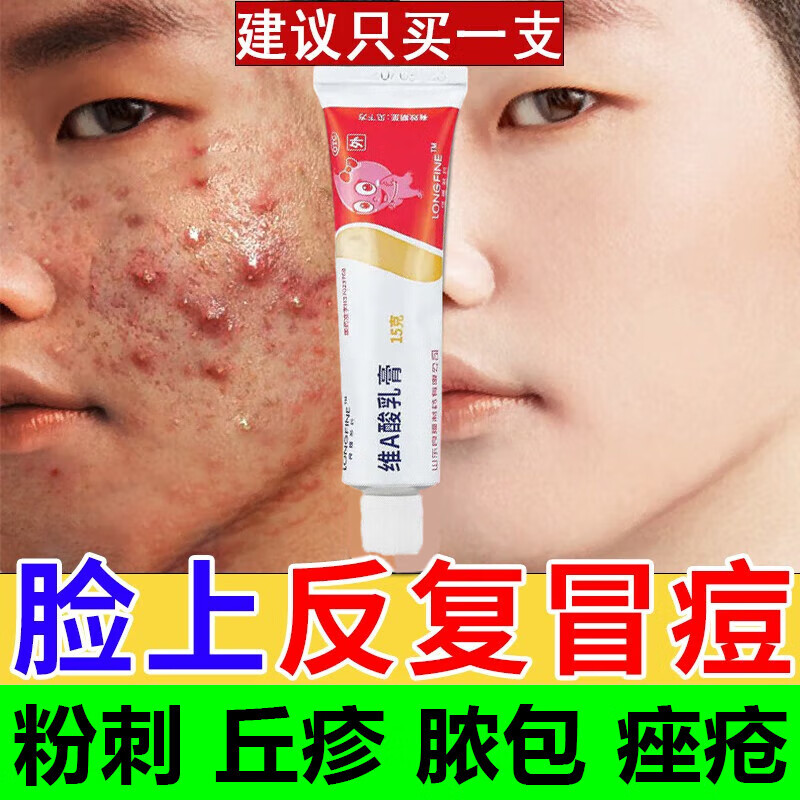 治疗脸上长痘痘的药 治痤疮粉刺脸上反复长痘痘青春痘熬夜长痘男女内