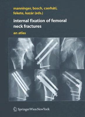 预订 Internal fixation of femoral neck fractures