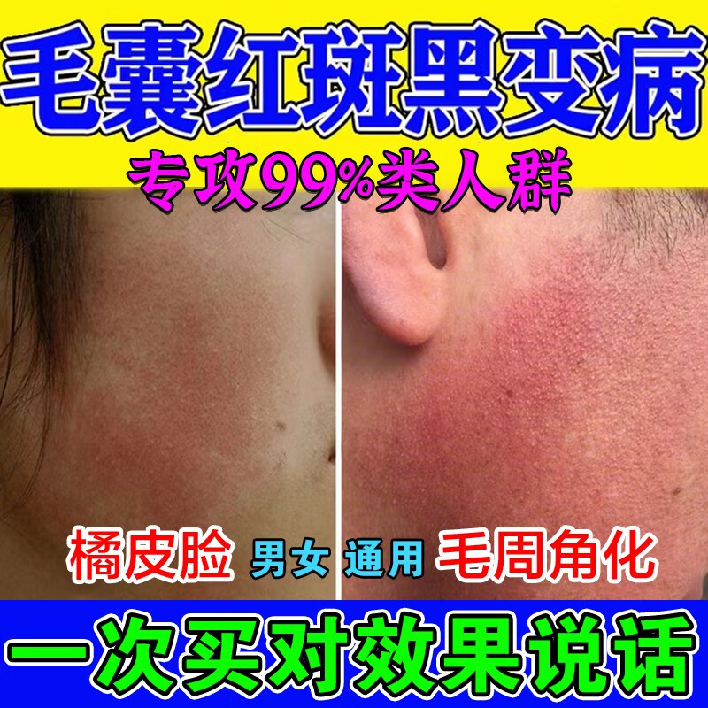 面颈部囊性红黑变病皮肤感染囊阻塞疙瘩痘痘 一盒装体验(小面积)