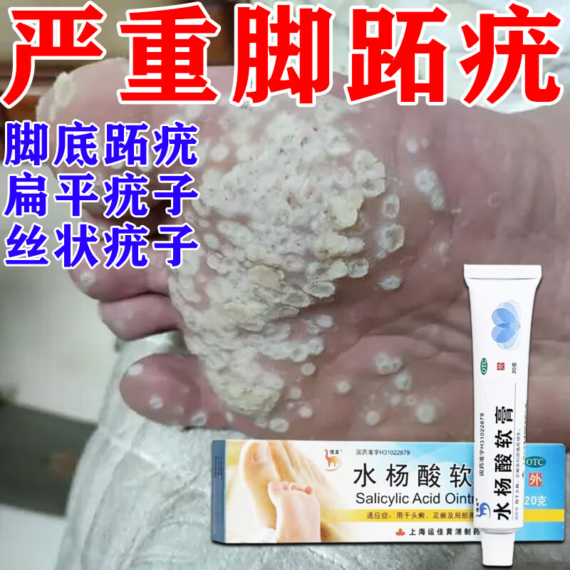 跖疣用什么药】治脚底跖疣肉粒蜂窝状足底脱皮瘙痒刺猴脚上鸡眼反复