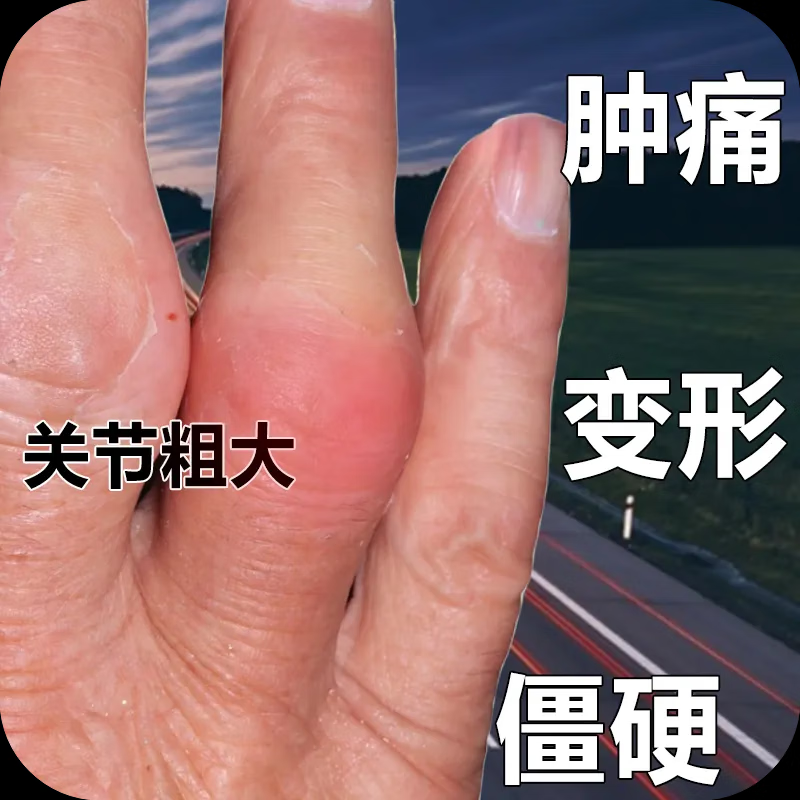 无品牌手指骨节肿胀变形手指关节疙瘩鼓包手指肿大手部防护手指疼痛 1