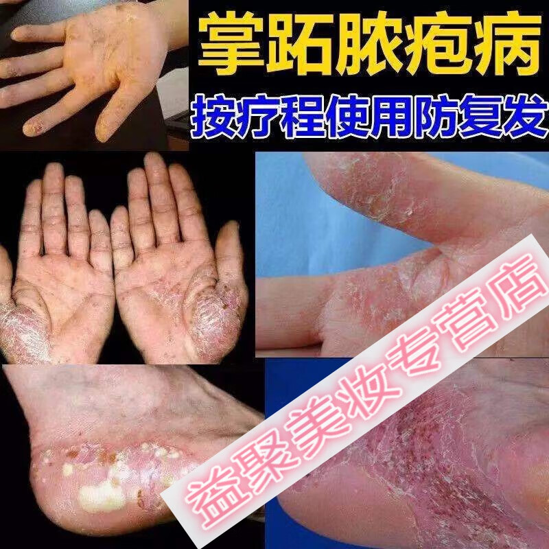 掌跖脓包病掌趾脓疱手足脚起浓泡脱皮干裂掌跖角化症红l斑脓包膏 2 1