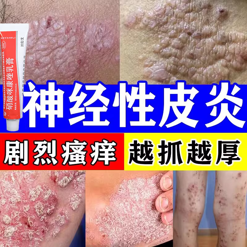 皮肤瘙痒止痒特专心用新效期药 皮肤瘙痒皮炎湿疹真菌 过敏药止痒抑菌