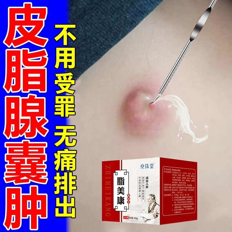 皮脂腺异位囊肿粉瘤痘痘去除膏消皮下脓包火疖子毒神l器囊肿速消 单盒