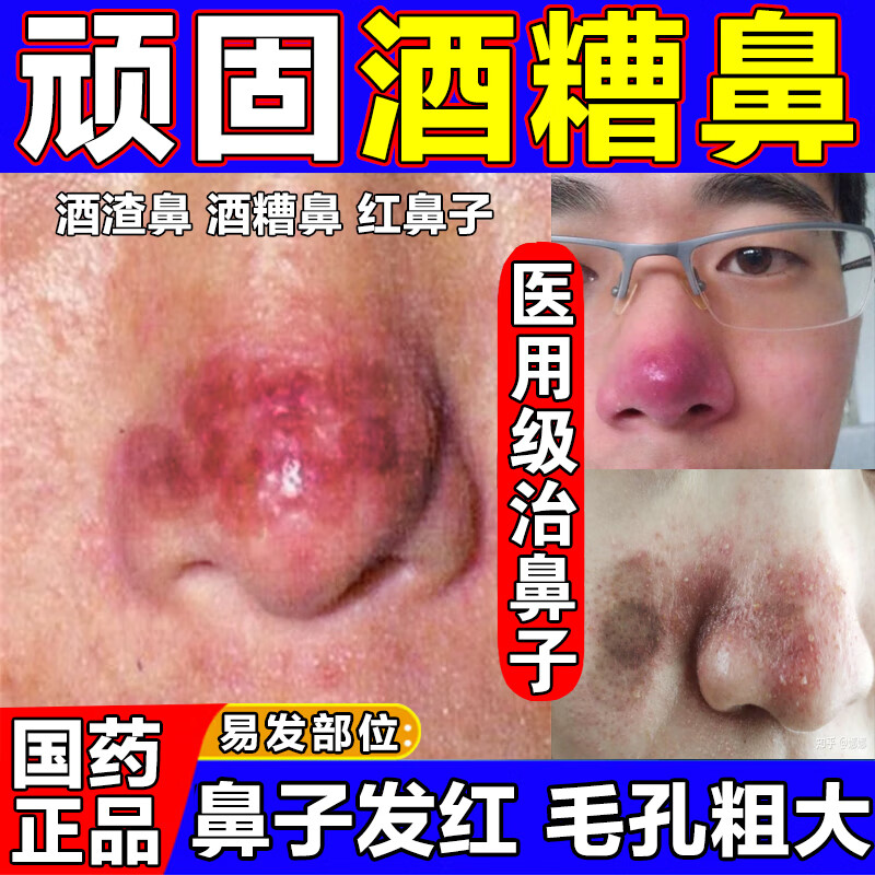 酒糟鼻专用药膏治酒渣鼻红鼻子草莓鼻药膏 修复鼻子红血丝粉刺去黑头
