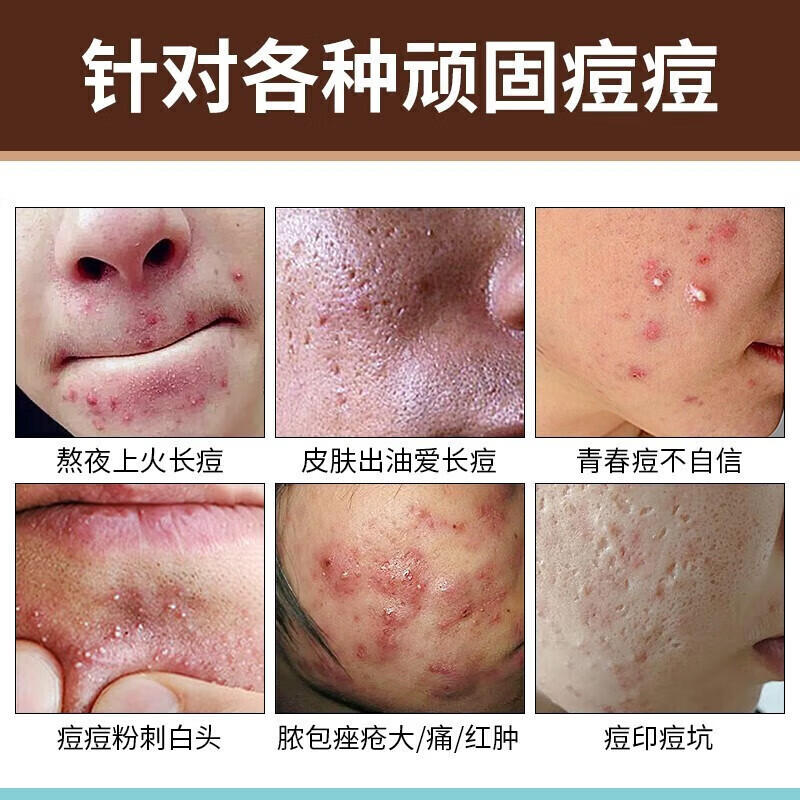 拜迪生物祛痘膏祛痘印去痘疤淡化痘坑祛痘凝胶青春痘闭口粉 祛痘凝胶1