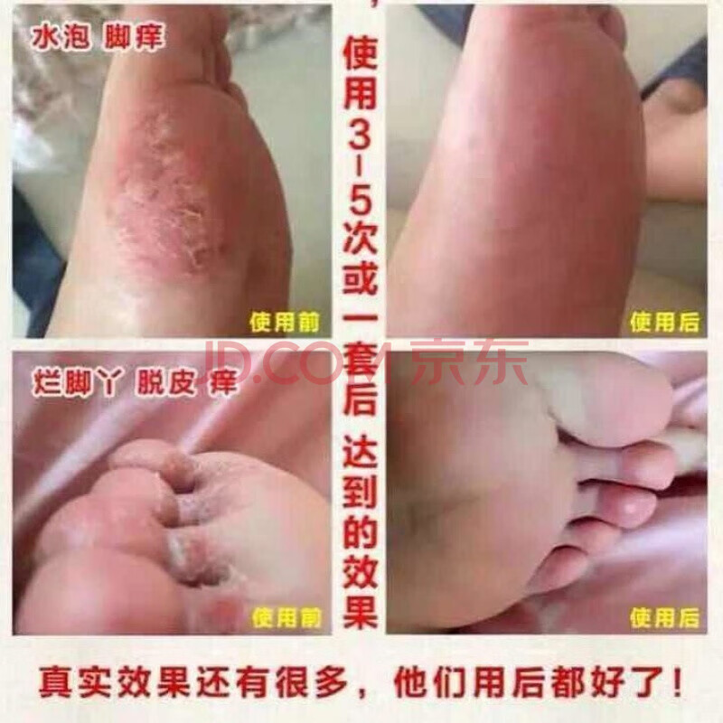 老津医脚气喷雾剂痒膏脚脱皮烂l脚丫真菌感染去l脚臭脚气汗脚锐皮水泡 喷剂+乳膏，
