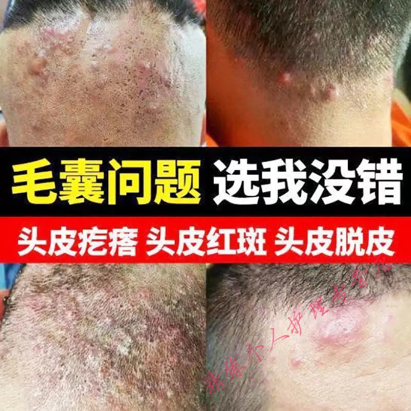 头上长疙瘩专治头皮毛囊炎头皮痘痘背部脓包疙瘩痘痘红肿皮肤毛囊炎
