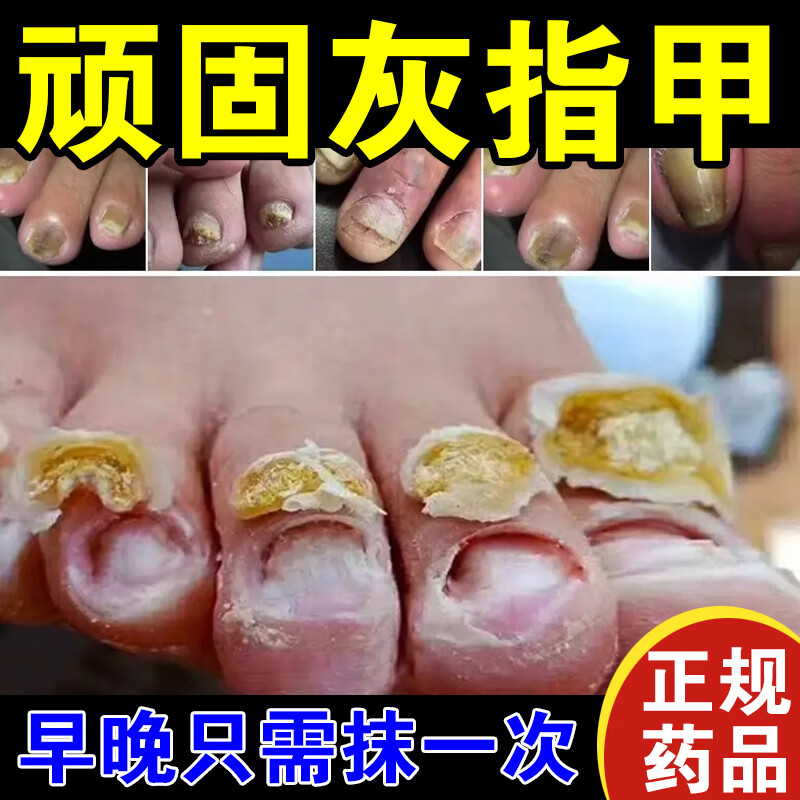 盐酸特比萘芬乳膏 1盒【指甲变色增厚】