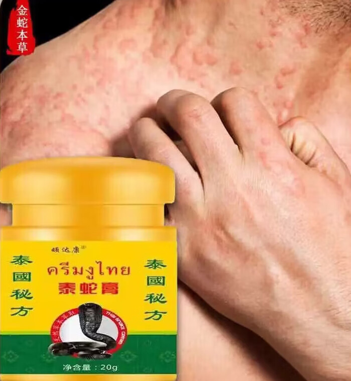 顽达康泰蛇膏泰国秘方牛l皮l癣银l屑湿l疹皮l炎膏痒膏皮肤骚痒症 单