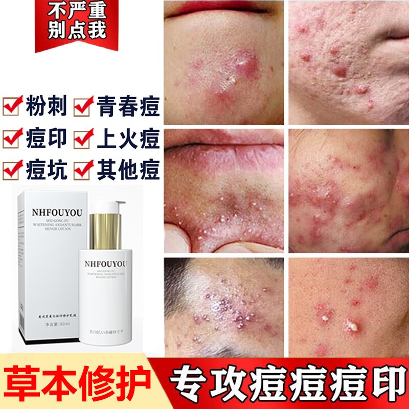 NHFOUYOU祛痘膏祛痘印修复淡化痘印痘坑青春痘美攻芙美白祛印修护乳液 1瓶【轻度痘痘】