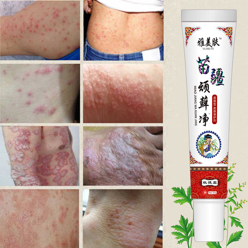 牛皮癣顽癣净喷剂苗药湿毒抑菌膏皮肤瘙痒止痒全身红痒干痒湿疹膏去