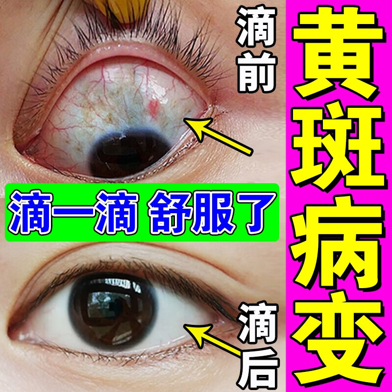 药房直售  黄斑病变眼药水眼底发黄出血黄斑囊样水肿看不清叶黄素 单