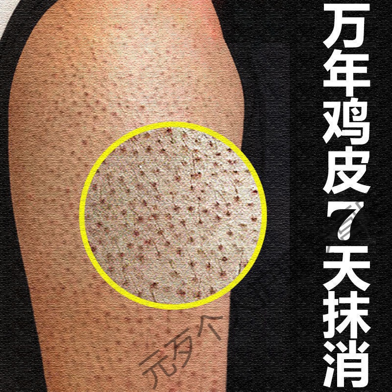 jsf【官方】去l鸡皮肤毛囊角质疙瘩大腿手臂毛周角化修复皮肤干燥男 