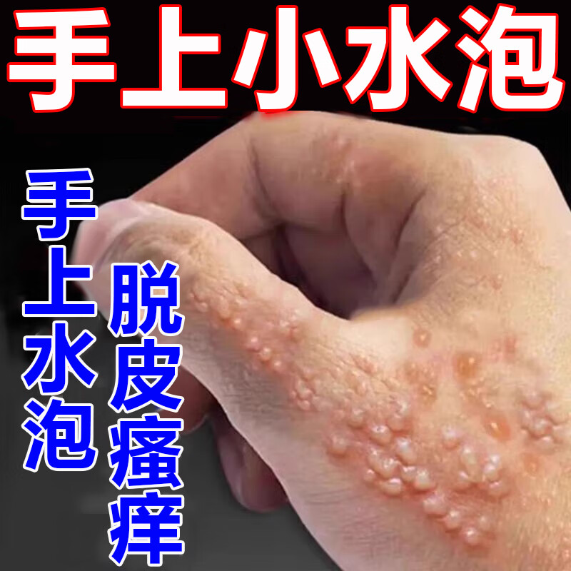 汗疱疹药膏 手上起小水泡手干脱皮手指真菌感染带状疱疹外涂手上长