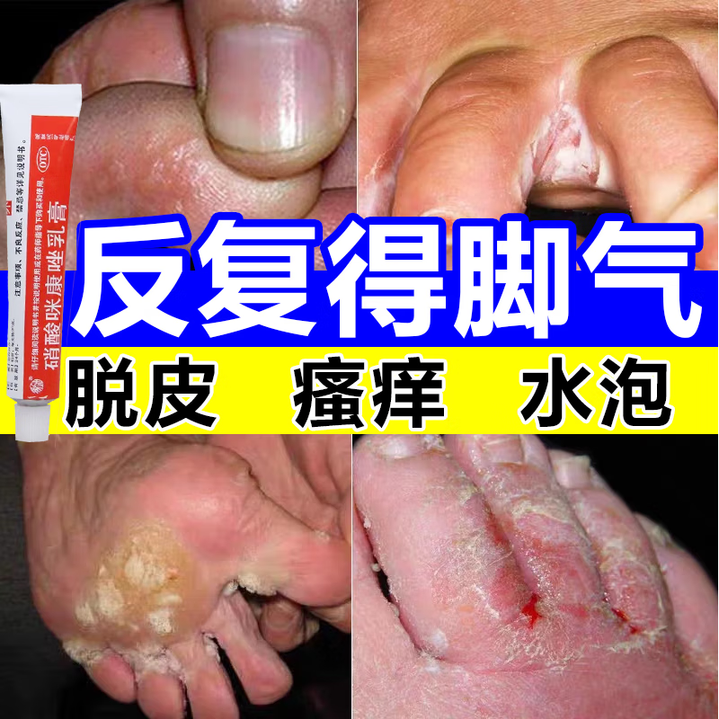 脚气脚臭脱皮烂脚丫真菌感染药膏长水泡脚趾痒脚汗脚臭脱皮糜烂 硝酸