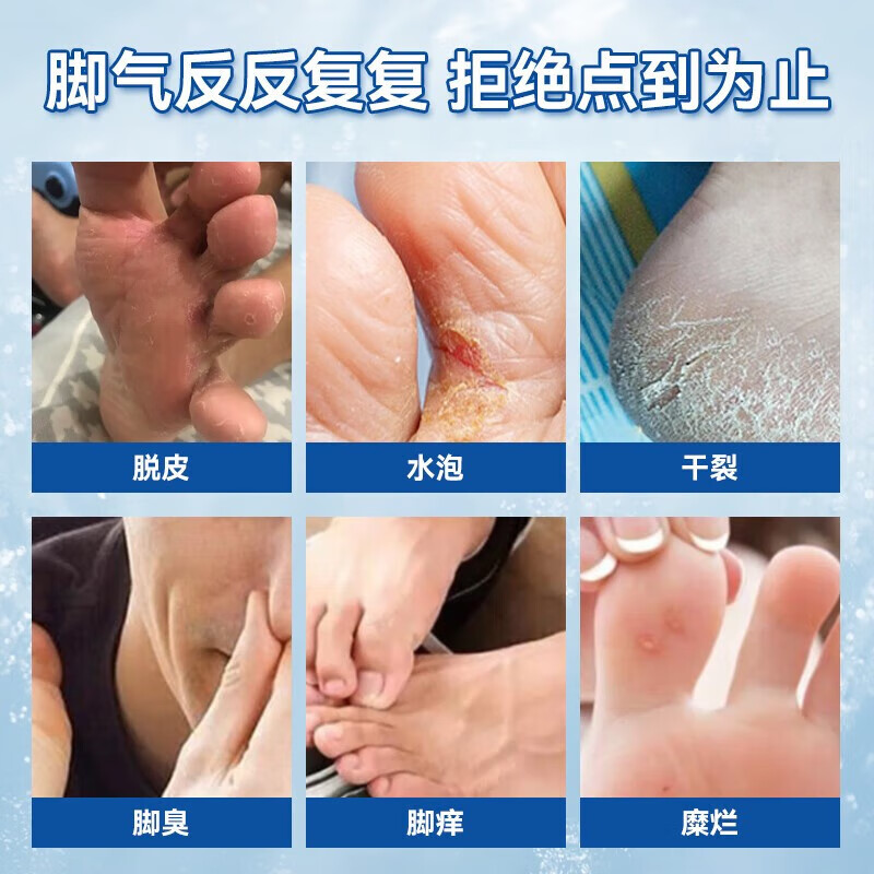 曲咪新乳膏治疗脚气药脱皮烂脚丫10g真菌感染水泡糜烂型脚臭脚出汗止