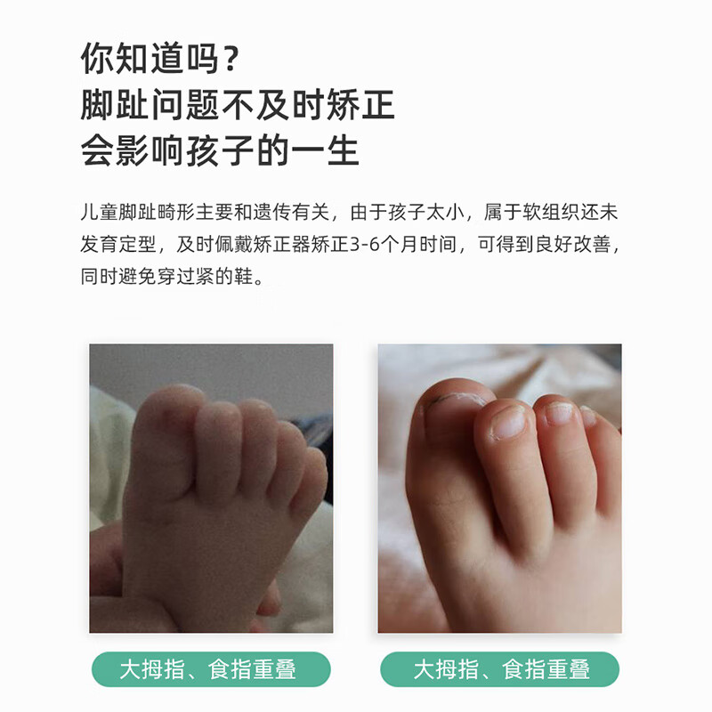 幼儿童脚趾器大拇指食指重叠外翻弯曲倾斜纠正挤压高低j6 大拇指食指1