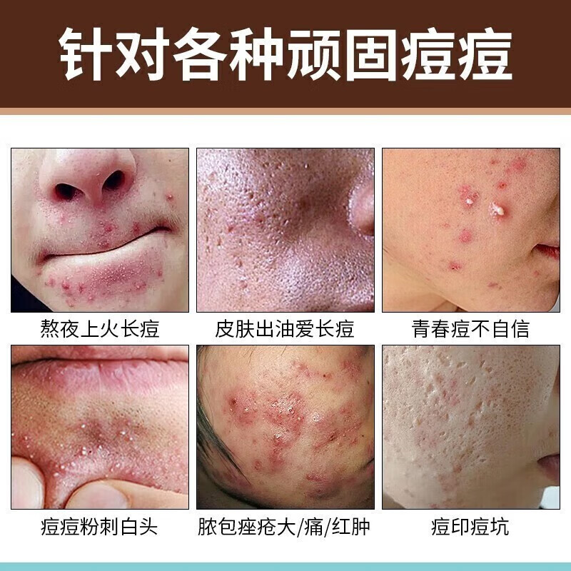 宫本武藏壬二酸祛痘膏15%凝胶皮傲宁祛痘印修复去痘疤淡化痘坑痤疮男女士 一盒装【轻度体验装】