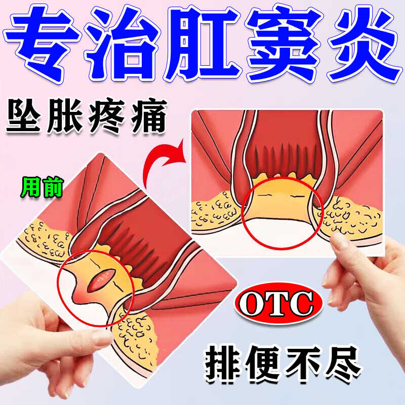 肛窦炎专用药】治肛周炎肛门发炎红肿疼痛出血肛周脓肿囊肿屁眼疼痛