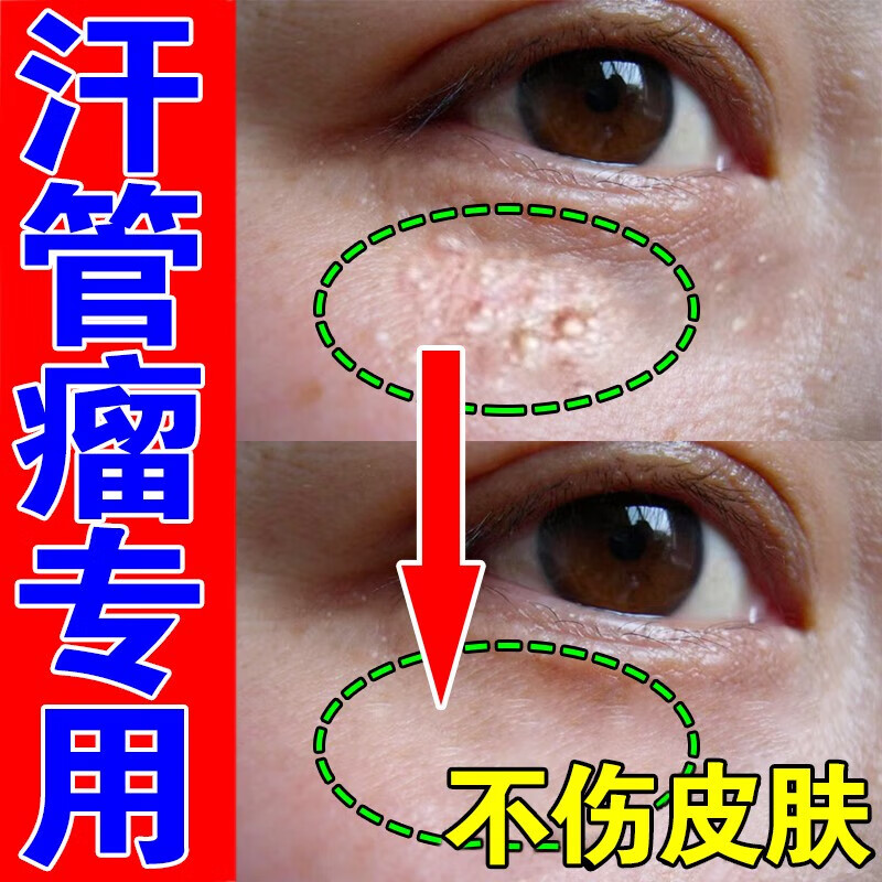 汗管瘤去除膏脂肪粒去除神器眼部专用汗管瘤油脂粒眼霜 单盒体验装