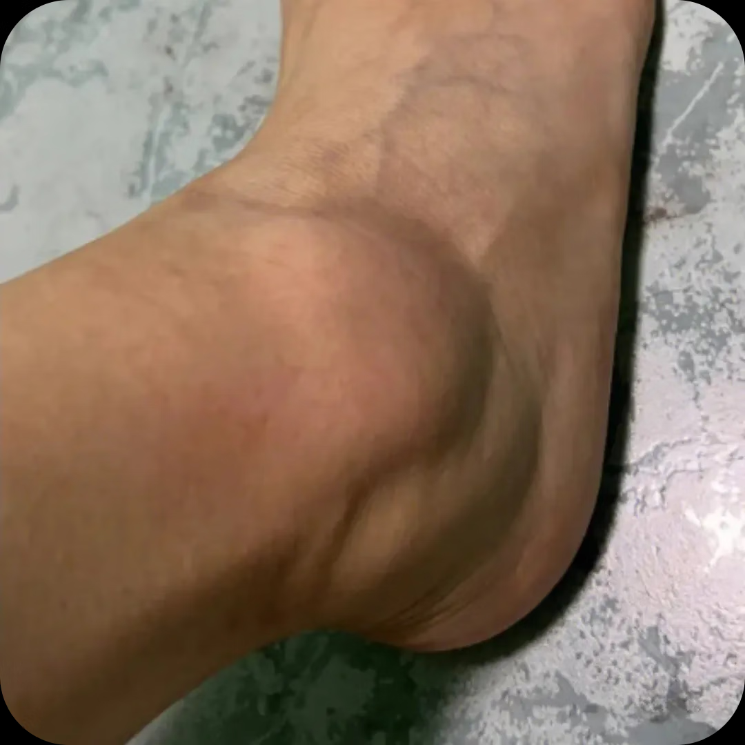 无品牌脚踝扭伤】陈旧伤脚腕肿痛足部防护脚腕关节痛骨关节炎一动就疼