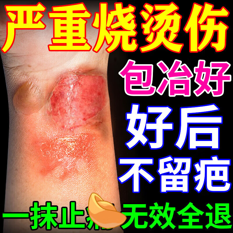 玖菲雷恩贝烫伤膏美宝烧伤烫伤膏皮肤外用家用成人儿童 烫伤膏2盒【买2送1  实发3盒】 官方授权