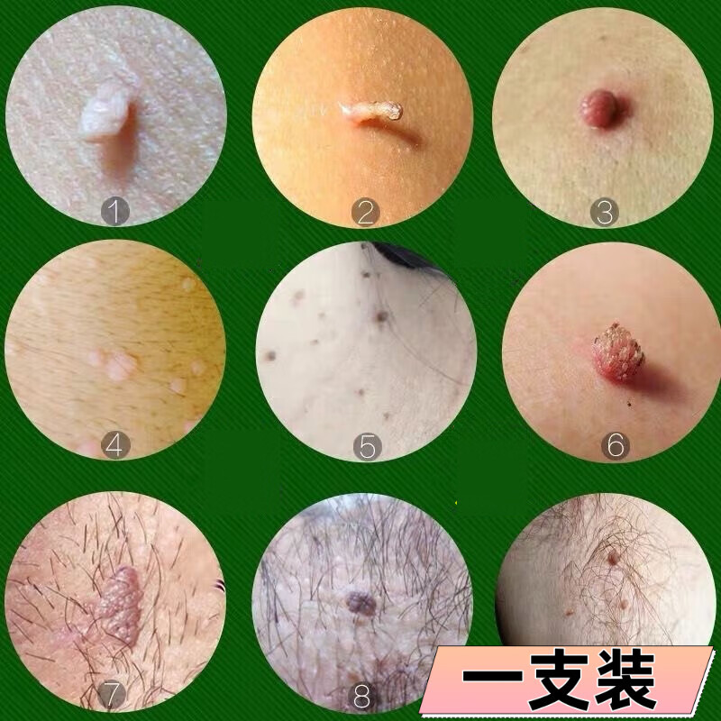 熏姿颜疣清宁去尤膏扁平尤猴子疙瘩小肉粒丝状尤腋下去除乳膏神器 1盒