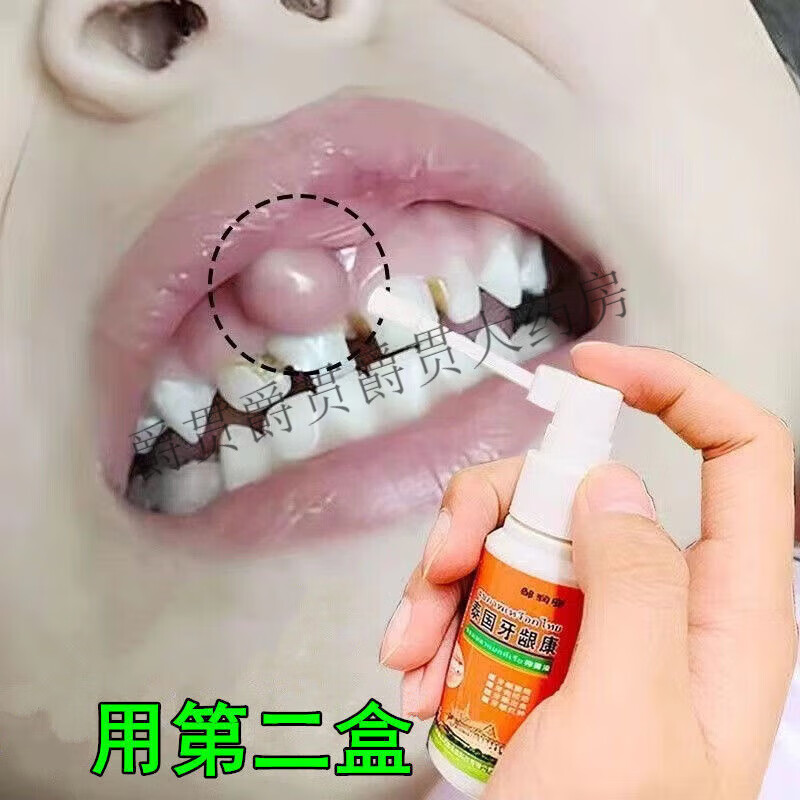 邹润安牙龈脓包流脓牙龈红肿牙槽脓肿牙龈息肉增生牙周炎牙龈肿痛 五