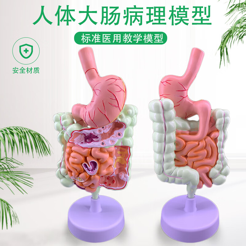 医学人体大肠病理解剖模型肠胃模型大肠病变模型肠道疾病人体结肠病变