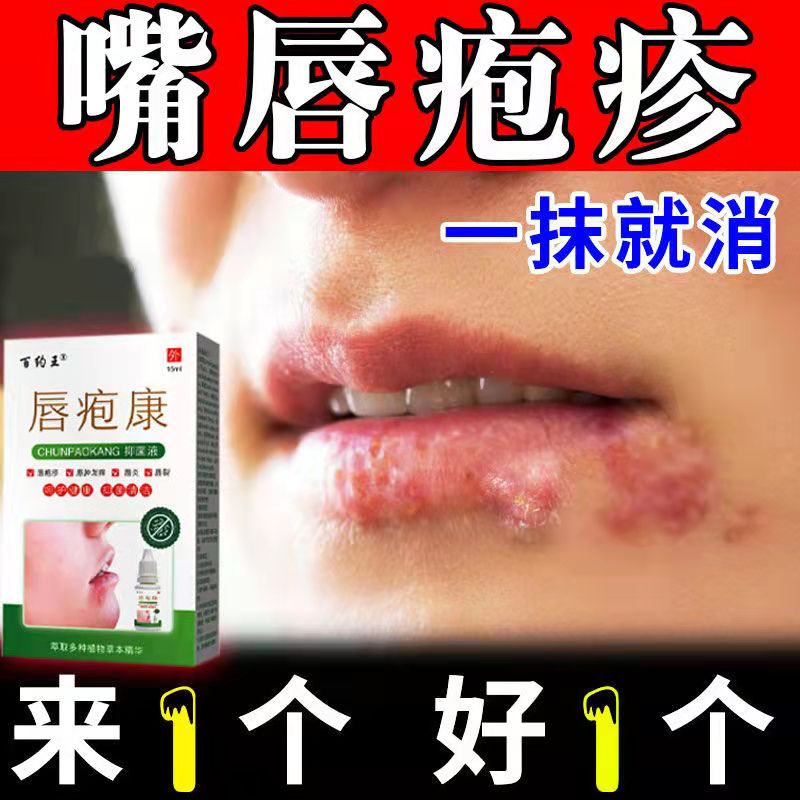 嘴角起泡烂嘴巴口角炎上火嘴角唇泡疹嘴巴脓疮舔嘴唇生疮红肿发痒溃烂