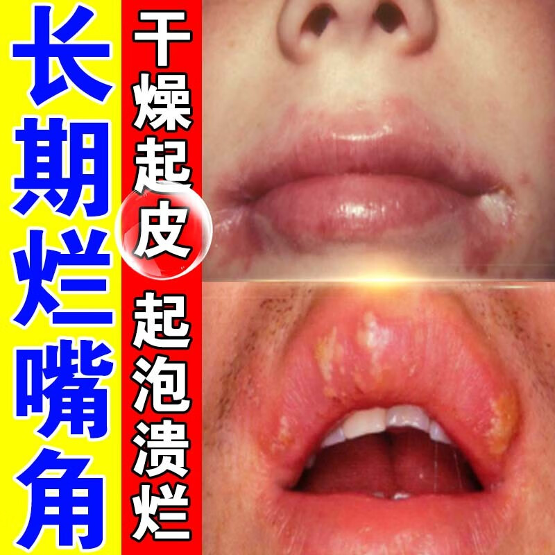 硝酸咪康唑乳膏 嘴角干裂疼痛张不开红肿出血嘴唇上火起泡烂嘴角 一盒
