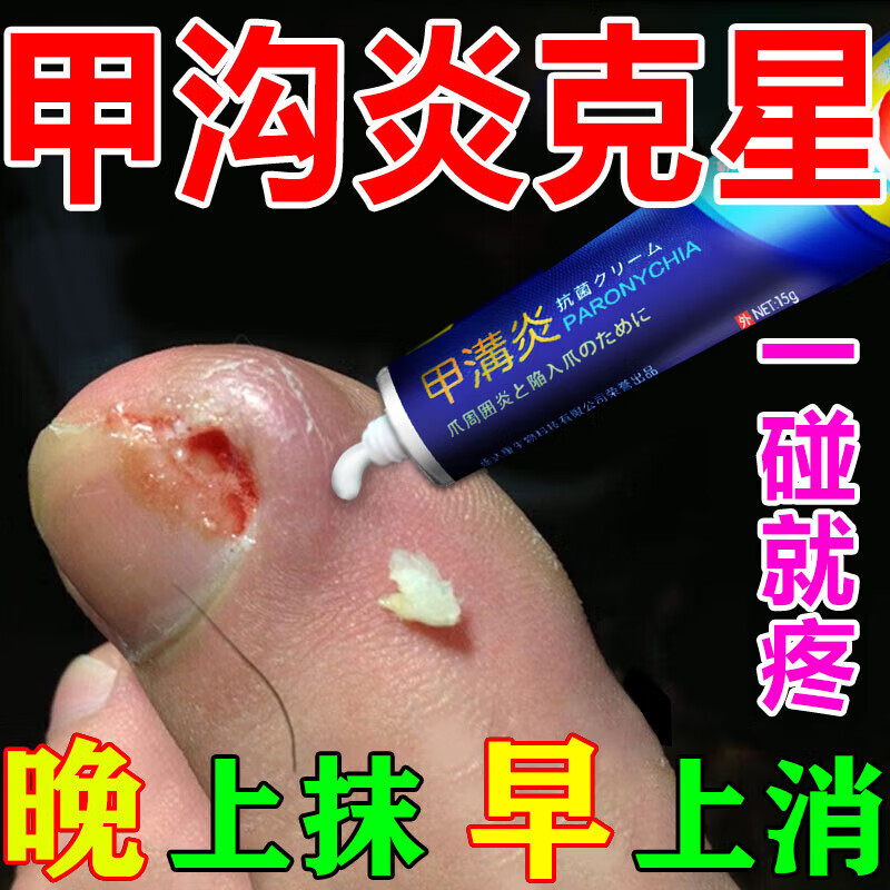 甲沟炎专用i药消肿去肉芽指甲长肉里矫正i器消肿止脚痛治疗甲沟炎 一