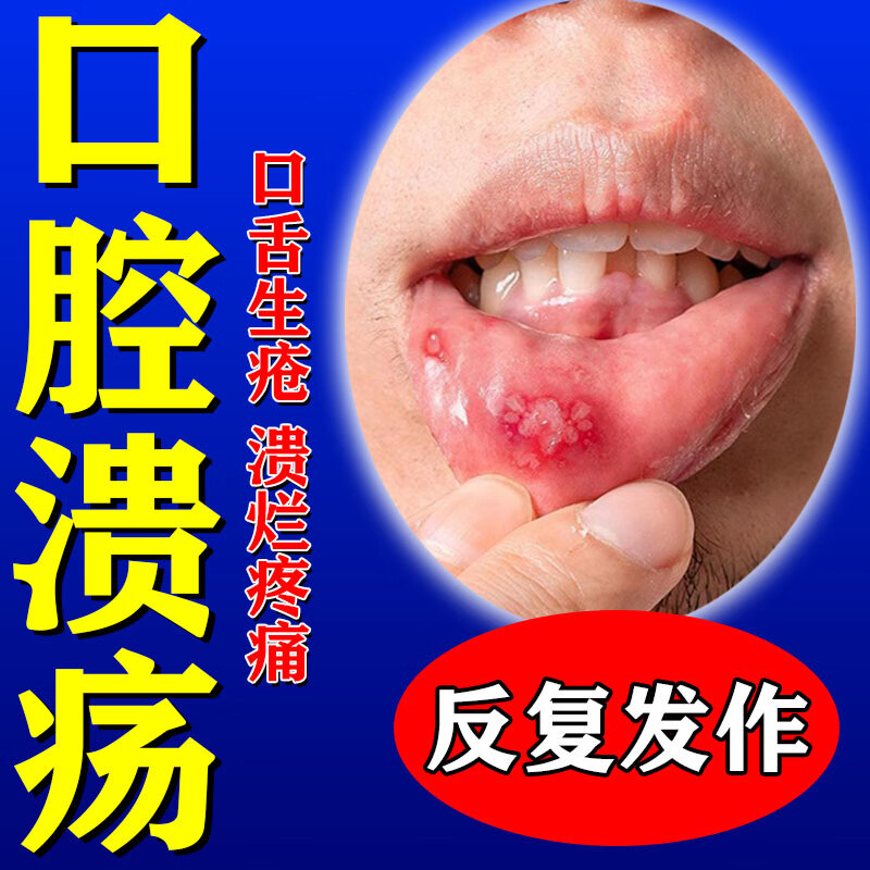 口腔溃疡贴】蜂胶口腔膜 20片 清热止痛 口舌生疮 复发性口疮烂嘴巴 5