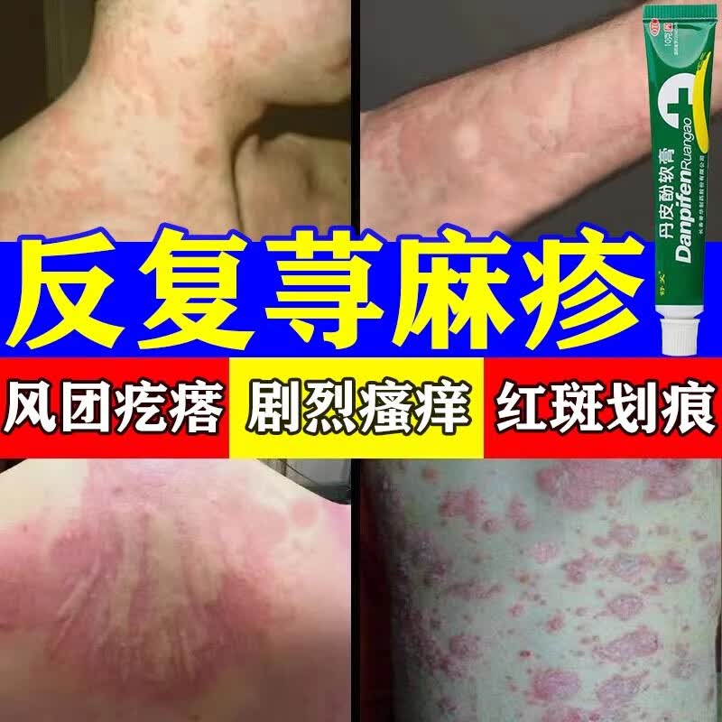 瘙痒红肿反复发作风团疙瘩红斑划痕越挠越痒皮肤过敏红疹丹皮酚软膏 1