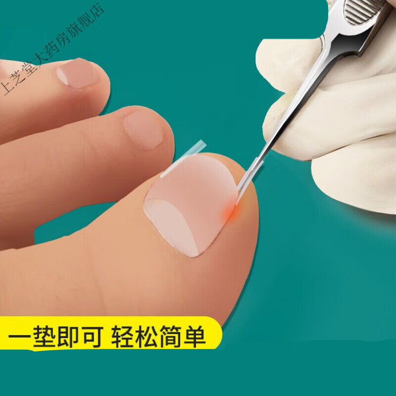 甲沟炎神i器指甲塞嵌甲脚趾甲沟隔离填充垫片脚指甲 甲沟隔离填充垫10