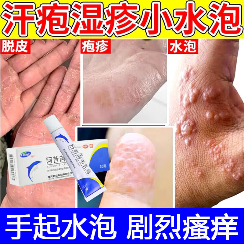 阿昔洛韦乳膏10g嘴角疱疹上火治疱疹水泡湿疹带状疱疹后遗症神经痛