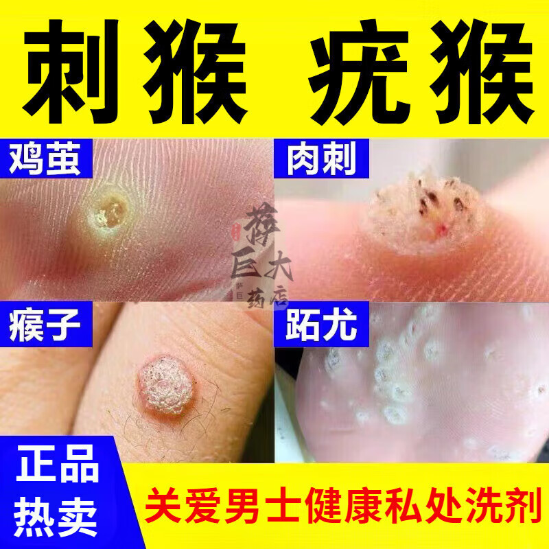 刺猴专用非药肉粒疙瘩拓疣鱼鳞痣扁平疣肉刺手脚脖子通用液体敷料膏 1