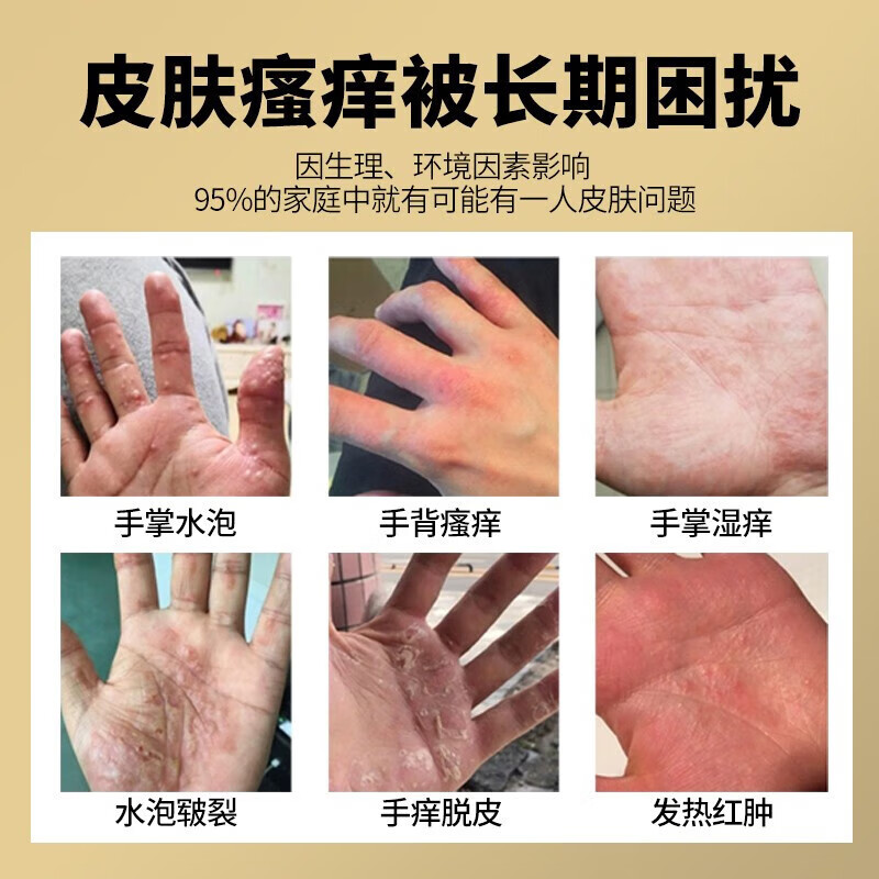 汗疱l疹膏手上起小水泡脱皮肤瘙痒干裂手癣鹅掌风真菌感染止皮痒膏 单