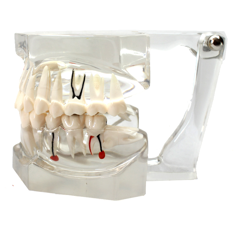 enovo颐诺牙齿模型2倍透明牙体病理模型口腔科病理模型医患模型齿科