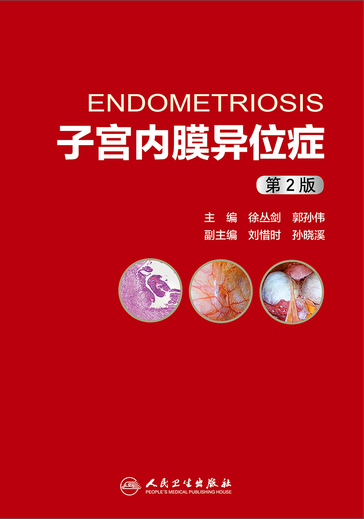子宫内膜异位症(第2版)