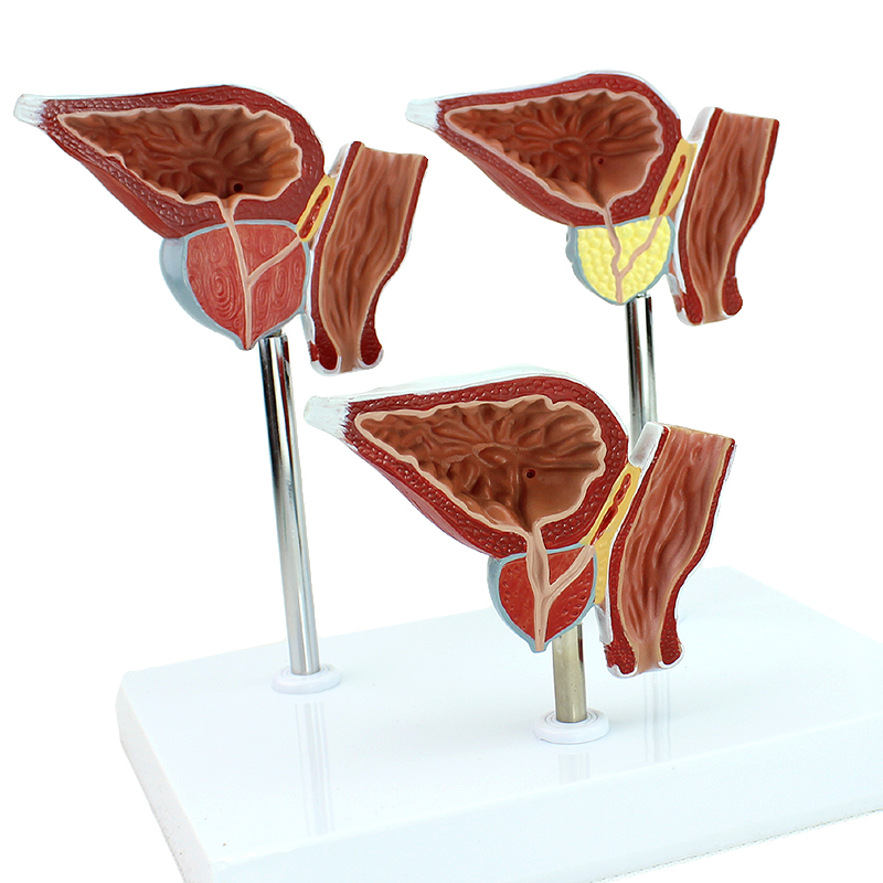 enovo颐诺前列腺病变模型医学模型男科医患沟通增生癌 bph检查男科