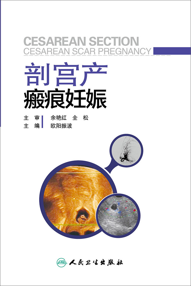 剖宫产瘢痕妊娠