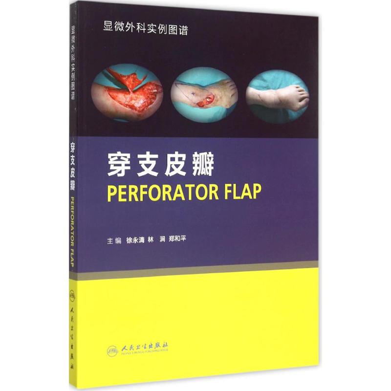 穿支皮瓣