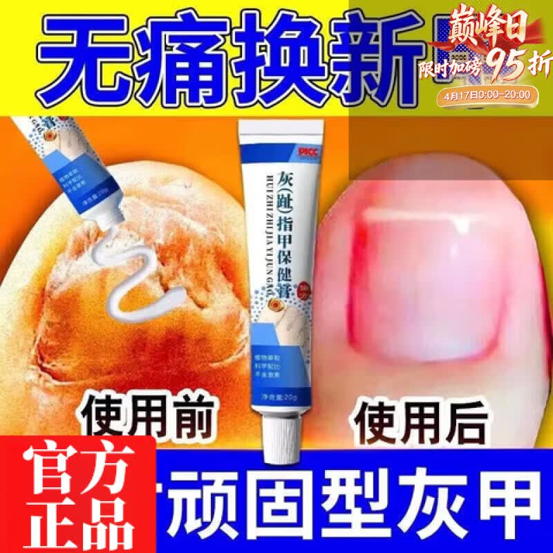 ? 灰指甲28元一支搞定！7天溶甲不伤肤，全家通用抑菌膏！