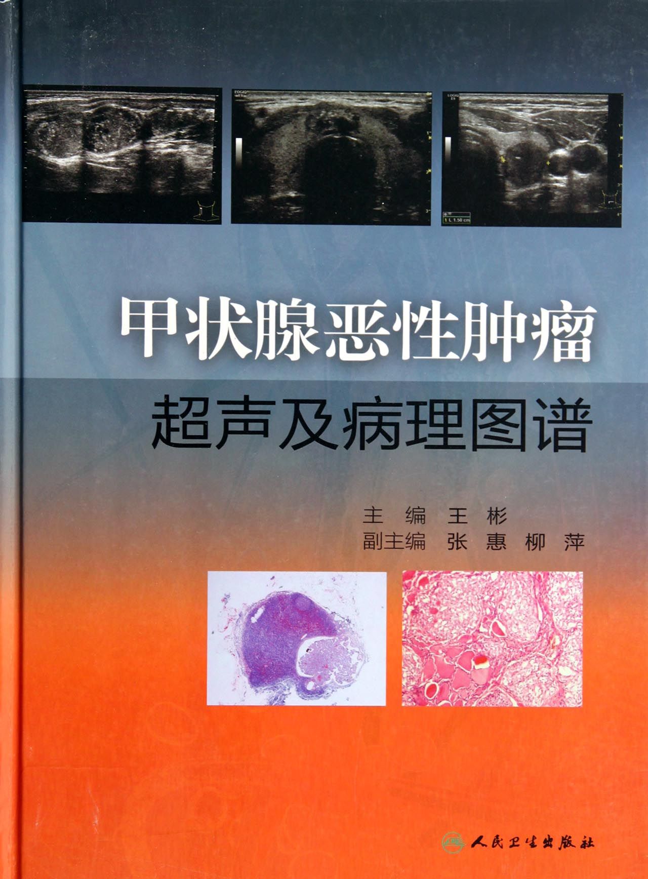 甲状腺恶性肿瘤超声及病理图谱(精)