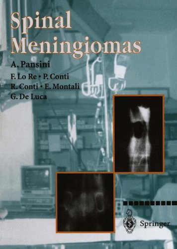 【预订】spinal meningiomas
